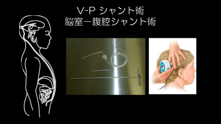 V-P シャント術／脳室−腹腔シャント術